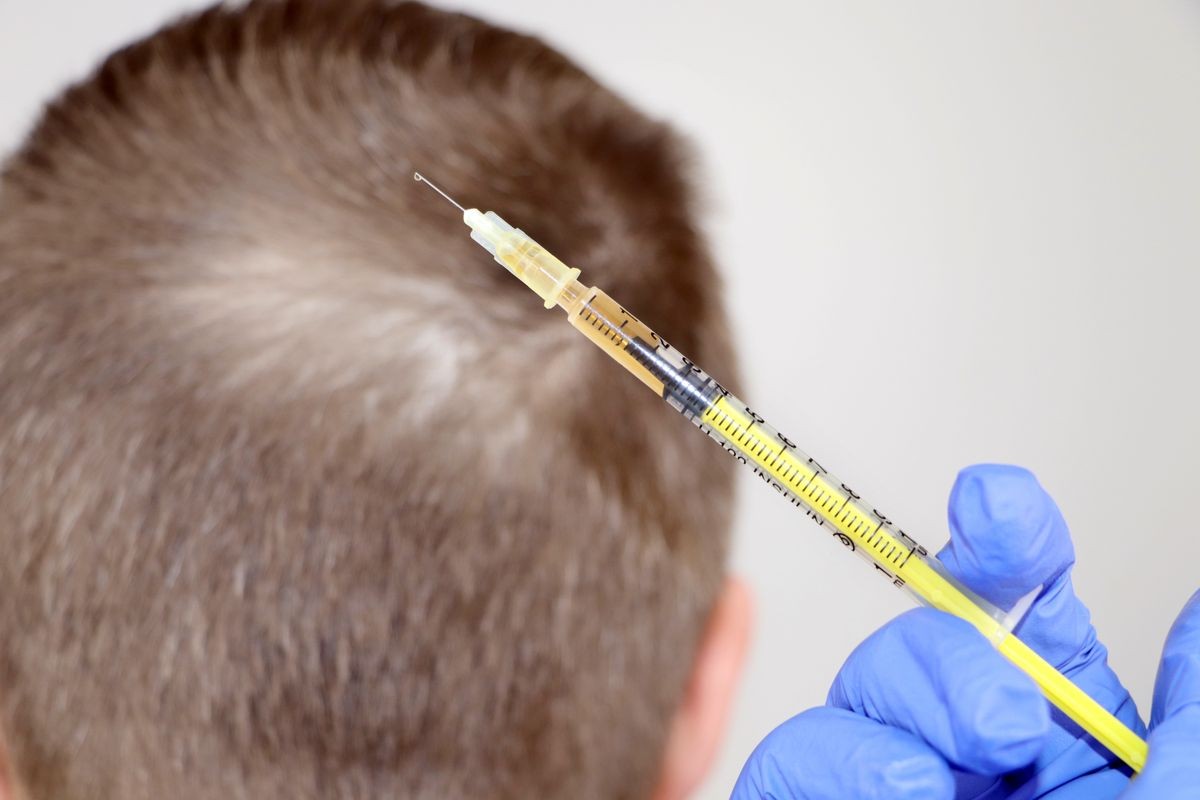 Hair mesotherapy or hair transplant: a beautician doctor makes injections in the man’s head for hair growth or to prevent baldness